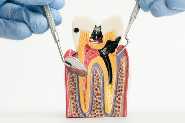 endodoncia endodoncia