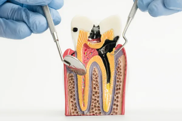 endodoncia endodoncia